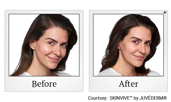 Results of SKINVIVE™ by Juvederm at Skinlastiq Medical Laser Cosmetic Spa in Burlingame