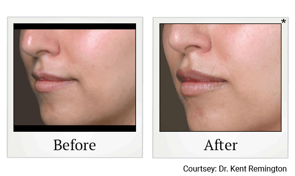 juvederm volbella before and after at Skinlastiq Medical Laser Cosmetic Spa in Burlingame