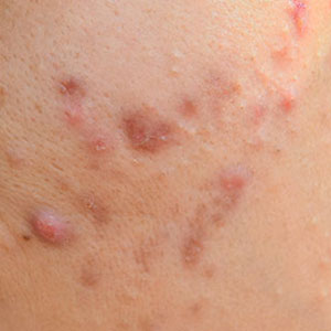 Skinlastiq Medical Laser Cosmetic Spa treats acne and acne scars