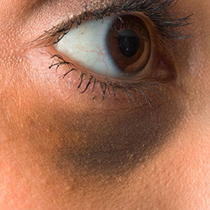 Skinlastiq Medical Laser Cosmetic Spa treats dark eye circles