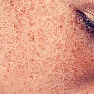Skinlastiq Medical Laser Cosmetic Spa treats freckles