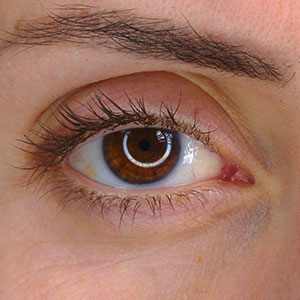 Skinlastiq Medical Laser Cosmetic Spa treats hollowed eyes