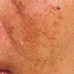 Skinlastiq Medical Laser Cosmetic Spa treats hyperpigmentation and dark spots