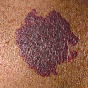 Skinlastiq Medical Laser Cosmetic Spa treats port wine stains