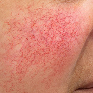Skinlastiq Medical Laser Cosmetic Spa treats rosacea
