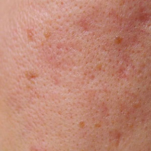 Skinlastiq Medical Laser Cosmetic Spa treats uneven skin texture