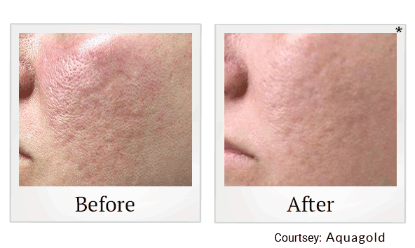 Aquagold results for acne at Skinlastiq Medical Laser Cosmetic Spa in Burlingame