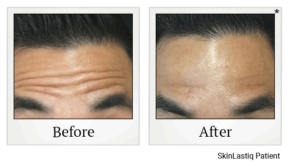 Botox results for crow’s feet at Skinlastiq Medical Laser Cosmetic Spa in Burlingame