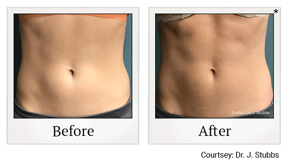 Evolve Tone Muscle Toning before and after at Skinlastiq Medical Laser Cosmetic Spa in Burlingame