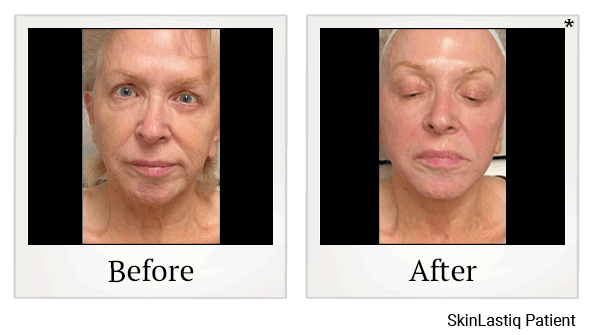 Forma Skin Tightening results for wrinkles at Skinlastiq Medical Laser Cosmetic Spa in Burlingame