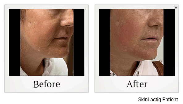 Forma Skin Tightening results for saggy skin at Skinlastiq Medical Laser Cosmetic Spa in Burlingame