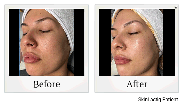Glo2Facials results for wrinkles at Skinlastiq Medical Laser Cosmetic Spa in Burlingame