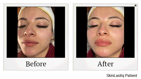 Glo2Facials results for crow's feet at Skinlastiq Medical Laser Cosmetic Spa in Burlingame