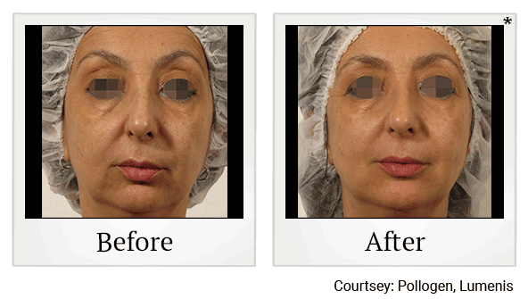 Glo2Facials results for hyperpigmentation at Skinlastiq Medical Laser Cosmetic Spa in Burlingame