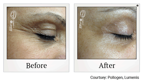 glo2facial before and after at Skinlastiq Medical Laser Cosmetic Spa in Burlingame