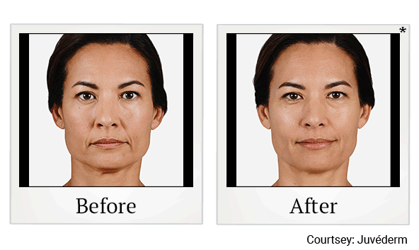 Juvederm results for creases at Skinlastiq Medical Laser Cosmetic Spa in Burlingame