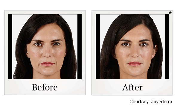 juvederm ultra before and after at Skinlastiq Medical Laser Cosmetic Spa in Burlingame