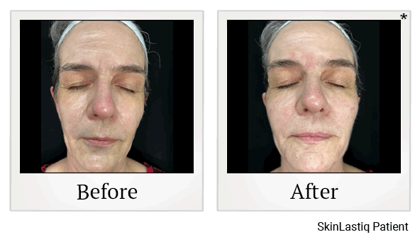 Juvederm results for volume loss at Skinlastiq Medical Laser Cosmetic Spa in Burlingame