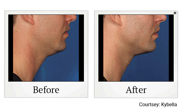 Kybella results for double chin reduction at Skinlastiq Medical Laser Cosmetic Spa in Burlingame