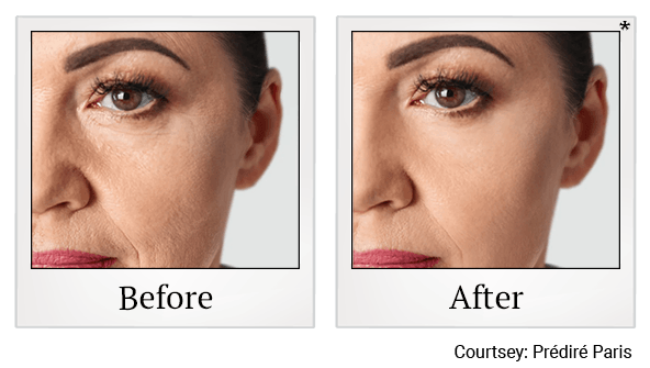 Prédiré Paris - LED Light Therapy results for Anti-Aging at Skinlastiq Medical Laser Cosmetic Spa in Burlingame