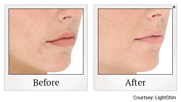 LED Light Therapy results for acne at Skinlastiq Medical Laser Cosmetic Spa in Burlingame