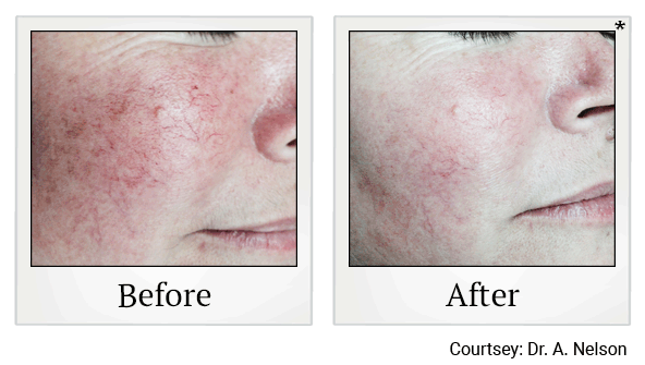 lumecca before and after at Skinlastiq Medical Laser Cosmetic Spa in Burlingame