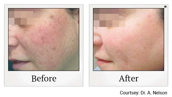 Lumecca IPL Treatments results for acne scars at Skinlastiq Medical Laser Cosmetic Spa in Burlingame