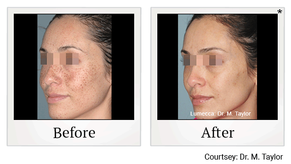 Lumecca IPL Treatments results for freckling at Skinlastiq Medical Laser Cosmetic Spa in Burlingame