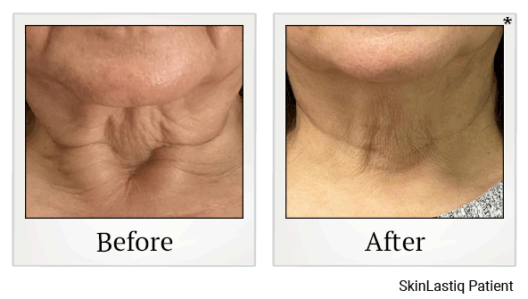 morpheus8 before and after at Skinlastiq Medical Laser Cosmetic Spa in Burlingame