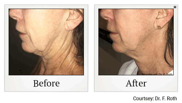 Morpheus8 RF Microneedling results for saggy skin at Skinlastiq Medical Laser Cosmetic Spa in Burlingame
