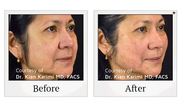 PDO Thread Facelift results for saggy skin at Skinlastiq Medical Laser Cosmetic Spa in Burlingame