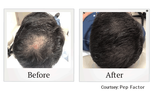 Pep Factor results for hair loss at Skinlastiq Medical Laser Cosmetic Spa in Burlingame