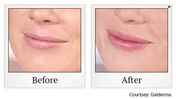 restylane kysse before and after at Skinlastiq Medical Laser Cosmetic Spa in Burlingame