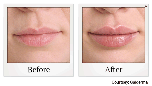 Restylane fillers results for lips at Skinlastiq Medical Laser Cosmetic Spa in Burlingame