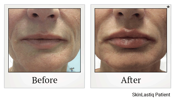 Revanesse Versa results for anti-aging at Skinlastiq Medical Laser Cosmetic Spa in Burlingame