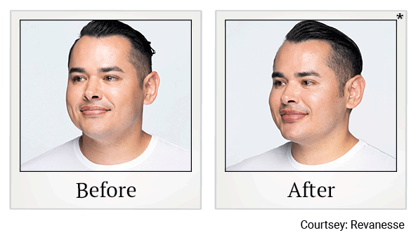 revanesse versa+ before and after at Skinlastiq Medical Laser Cosmetic Spa in Burlingame