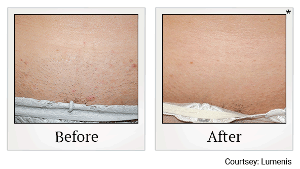 Laser Hair Removal before and after at Skinlastiq Medical Laser Cosmetic Spa in Burlingame