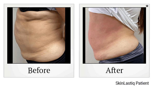 venus bliss before and after at Skinlastiq Medical Laser Cosmetic Spa in Burlingame