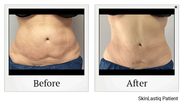 Venus Bliss Body Sculpting results for tummy at Skinlastiq Medical Laser Cosmetic Spa in Burlingame