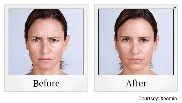 Xeomin results for frown lines at Skinlastiq Medical Laser Cosmetic Spa in Burlingame