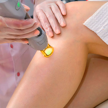 Patient receiving laser hair removal at Skinlastiq Medical Laser Cosmetic Spa in Burlingame